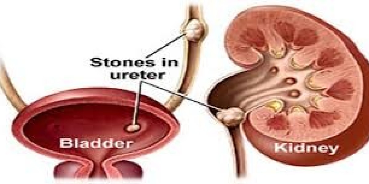 Renal Concretion: Causes, Symptoms & Treatment