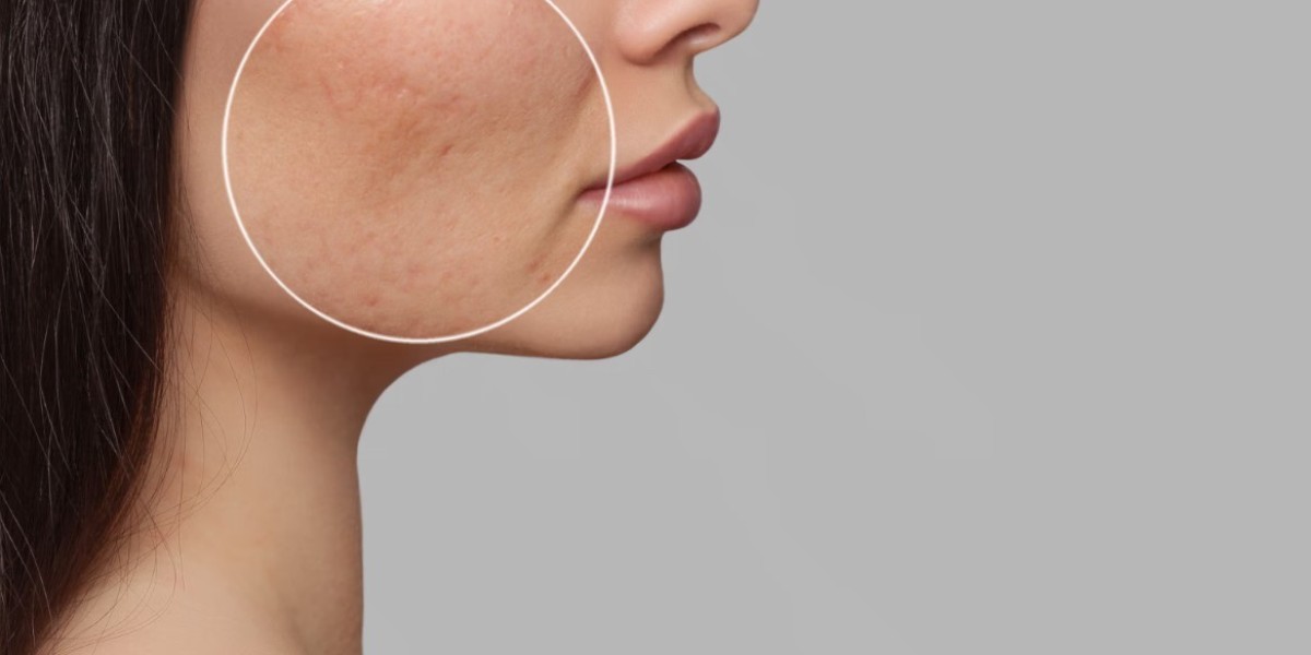 Top-rated clinics for acne scar treatment in Riyadh