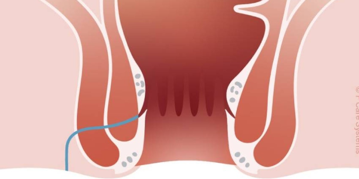How to cure fistula permanently without surgery