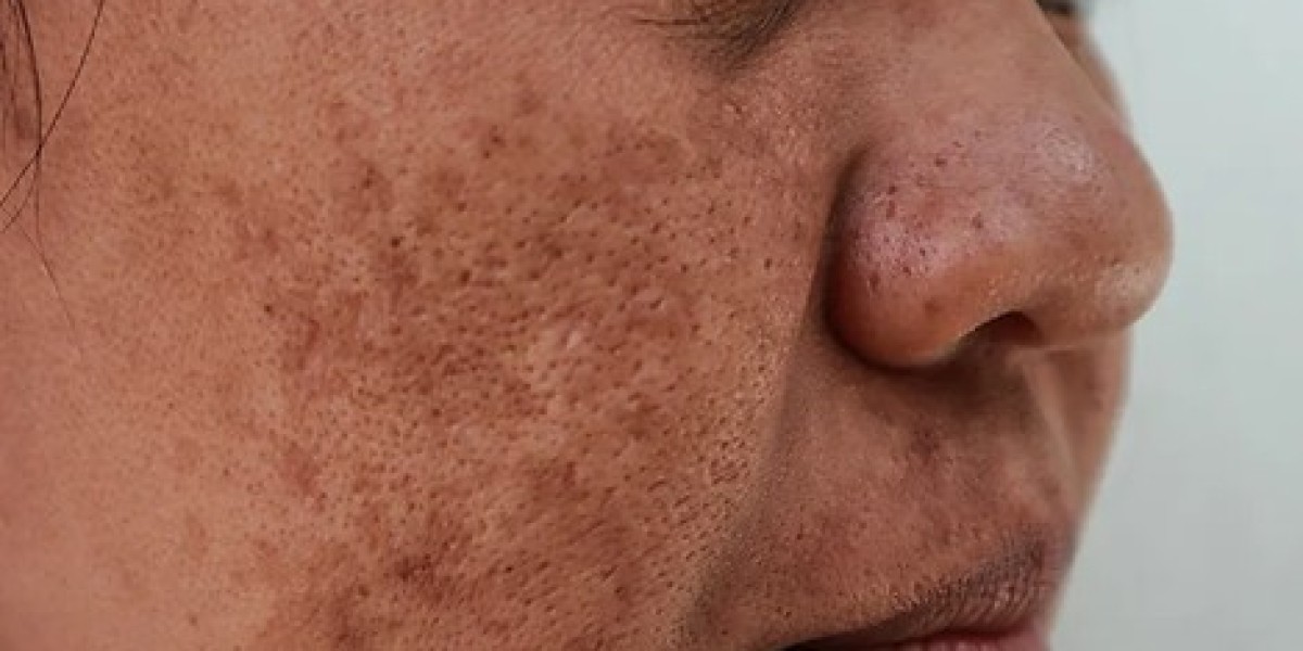 How Does Dermamelan Work on Dark Spots?