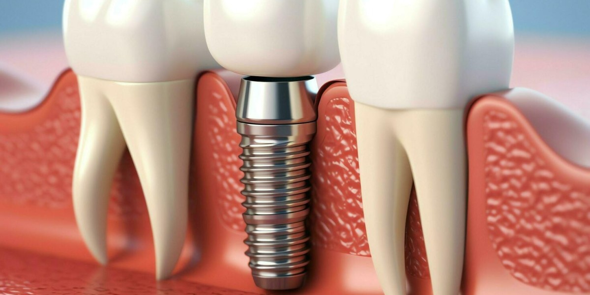Step-by-Step Guide to Dental Implant in Islamabad