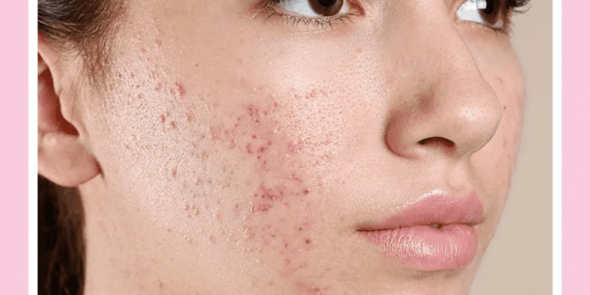 Does Organic Pumpkin Peel Help With Acne?