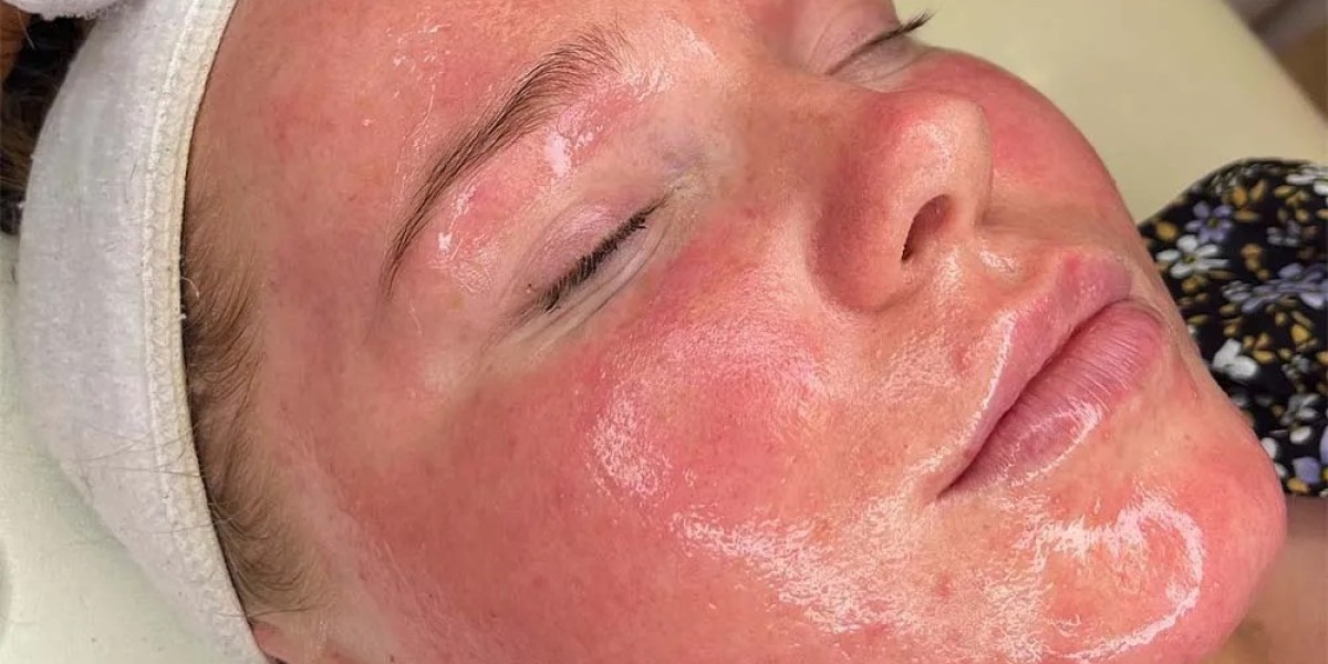 Can Chemical Peels Make Acne Worse?
