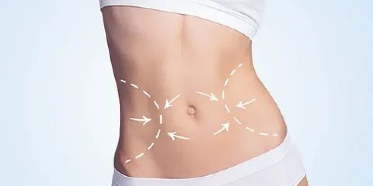 Body Sculpting in Riyadh: Navigating Your Recovery Journey