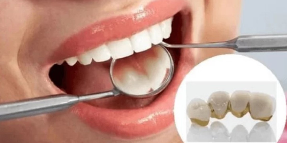 Răng Sứ Crom Coban Là Gì? Giá Bao Nhiêu? Có Tốt Không?