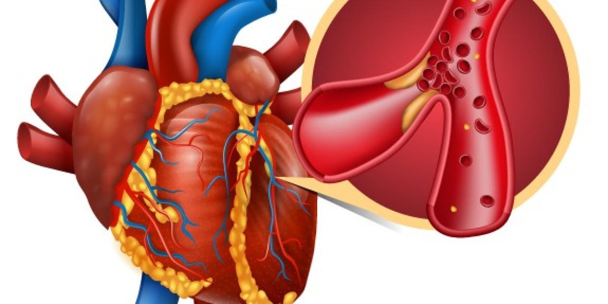 Myocardial Infarction Market Research | Drugs, Therapies and Forecast