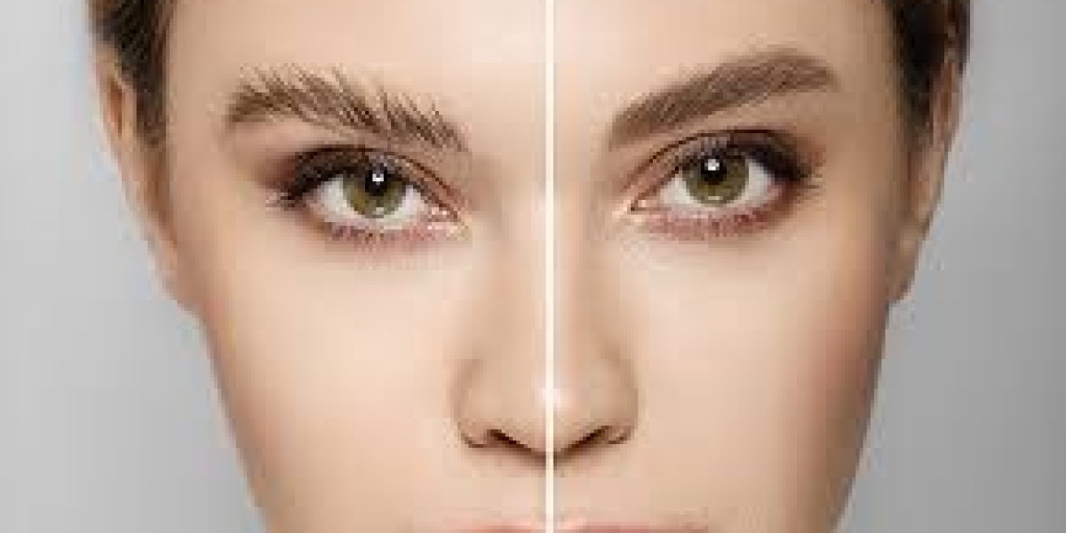 Guide to Eyebrow Transplantation in Turkey: Price, Procedure, and Recuperation