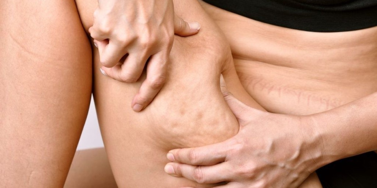Can Cellfina Permanently Remove Cellulite?