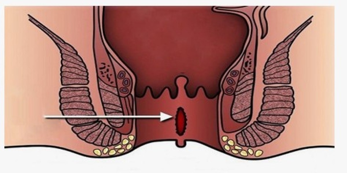 Anal Fissure Treatment Market Overview, Growth, Opportunities 2031