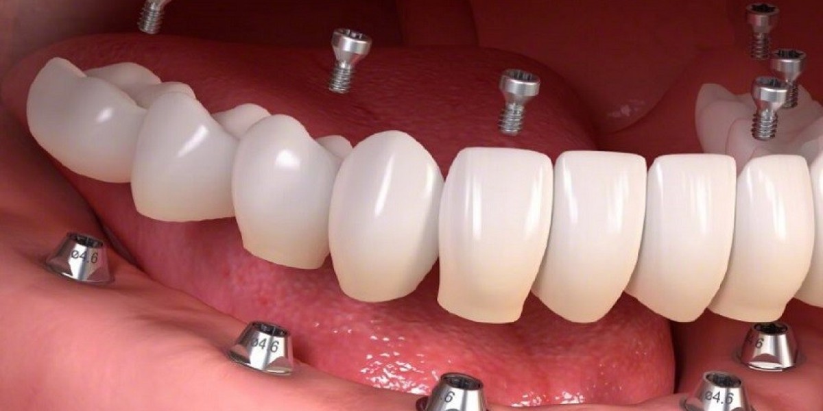 Trồng răng implant tại Hà Nội: Giải pháp phục hình răng mất an toàn, tiết kiệm và hiệu quả lâu dài