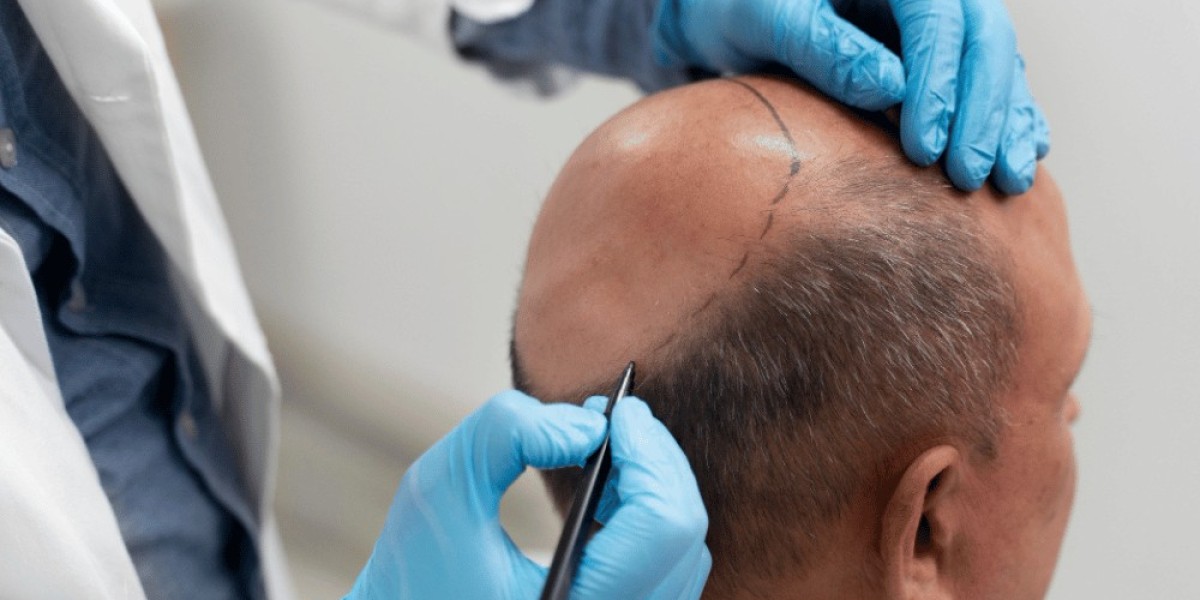 Does FUSS Hair Transplant Require Multiple Sessions?