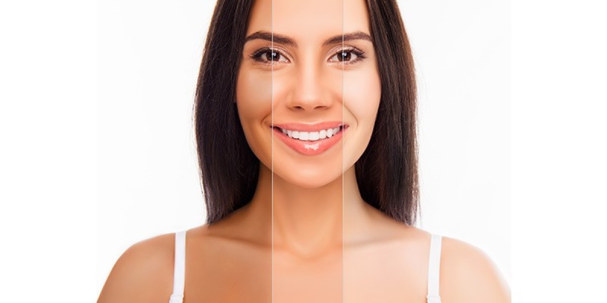How Skin Whitening in Islamabad Helps with Sunspots and Age Spots