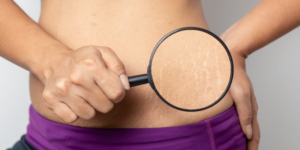 How Effective Is Laser Stretch Marks Treatment in Dubai?