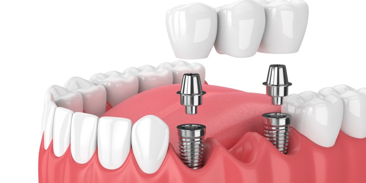 Restore What Truly Matters with Dental Implants Dubai