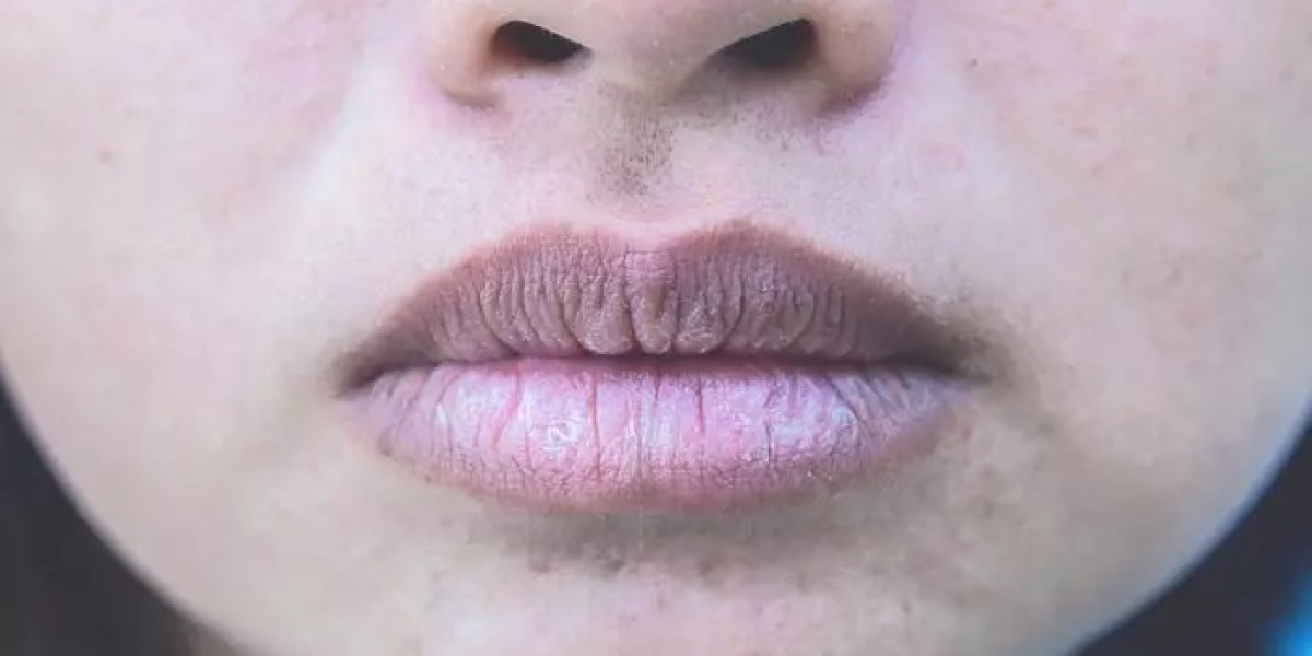 What Is Smoker’s Lips Treatment and How Does It Work?