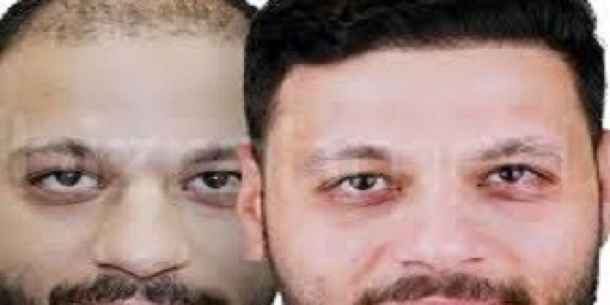 هل أنت مرشح مثالي لزراعة الشعر في الرياض؟ إجابة الأطباء بالتفصيل