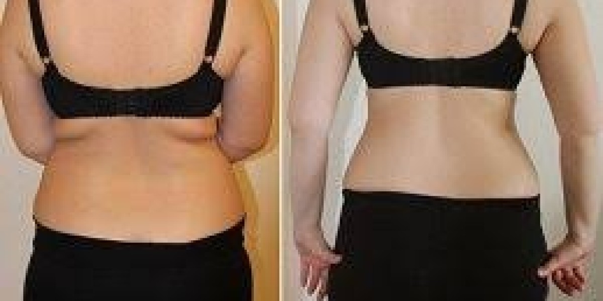 Mounjaro: The New Weight Loss Revolution in Peshawar