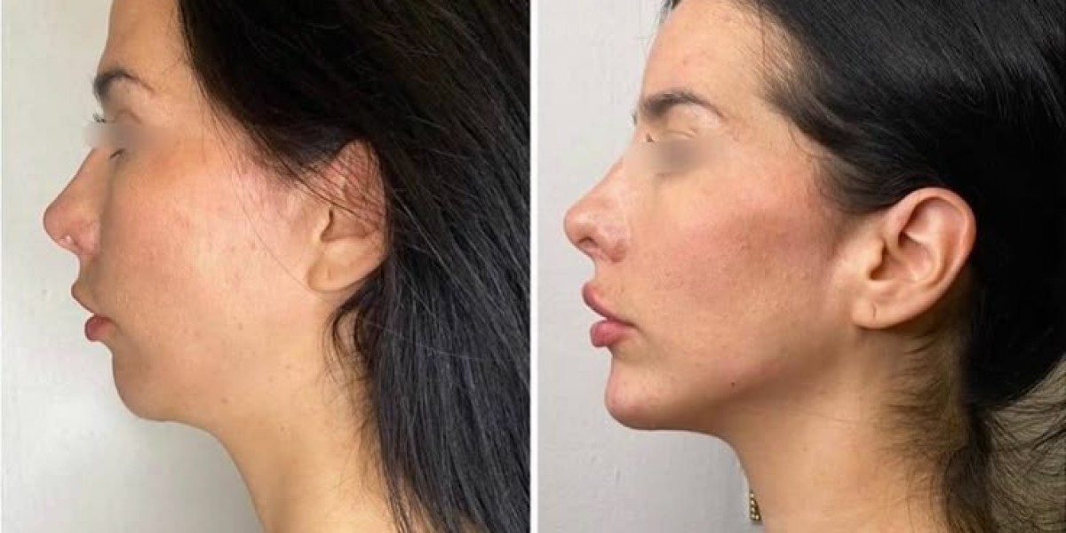 Debunking Myths About Jaw Surgery in Islamabad
