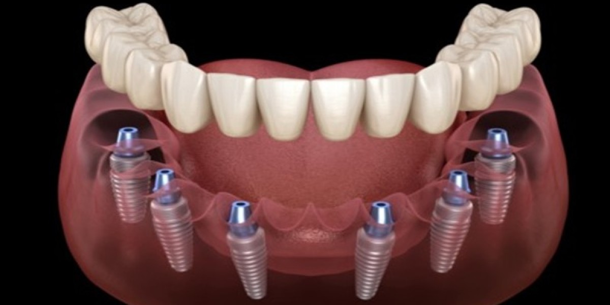 Trụ Implant Hàn Quốc loại nào tốt – Giá bao nhiêu? 