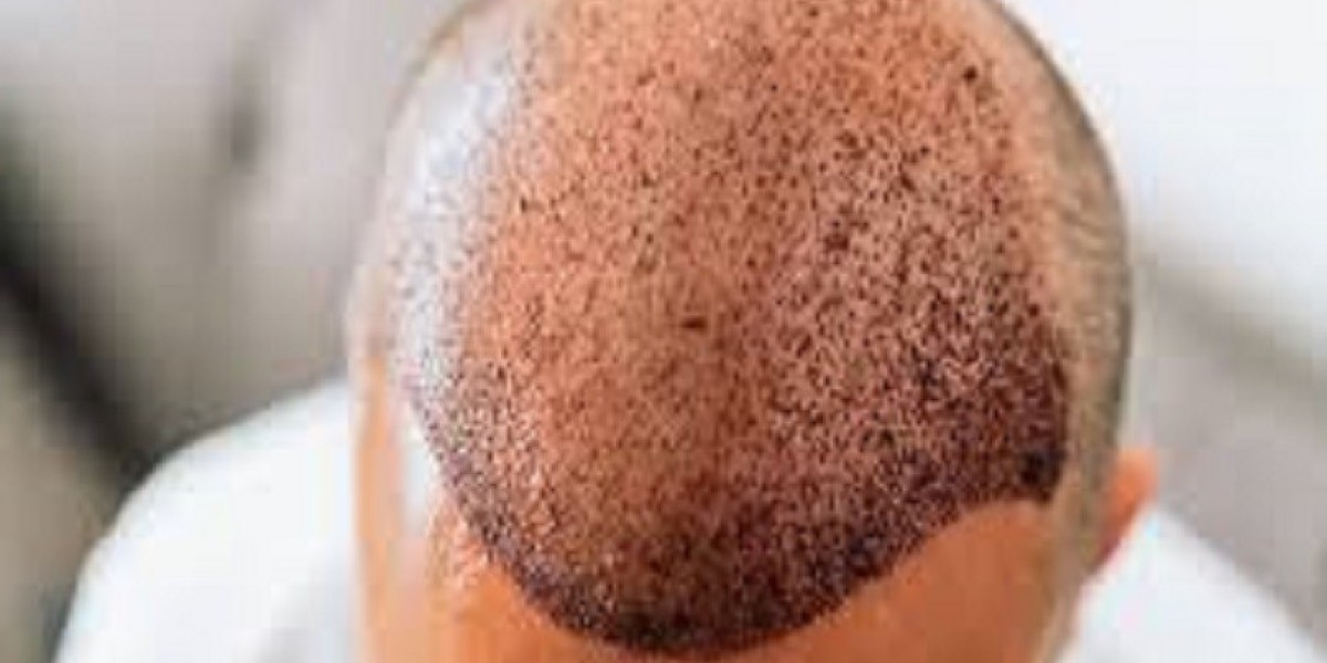 Get Fuller Hair with Expert Hair Transplant in Islamabad