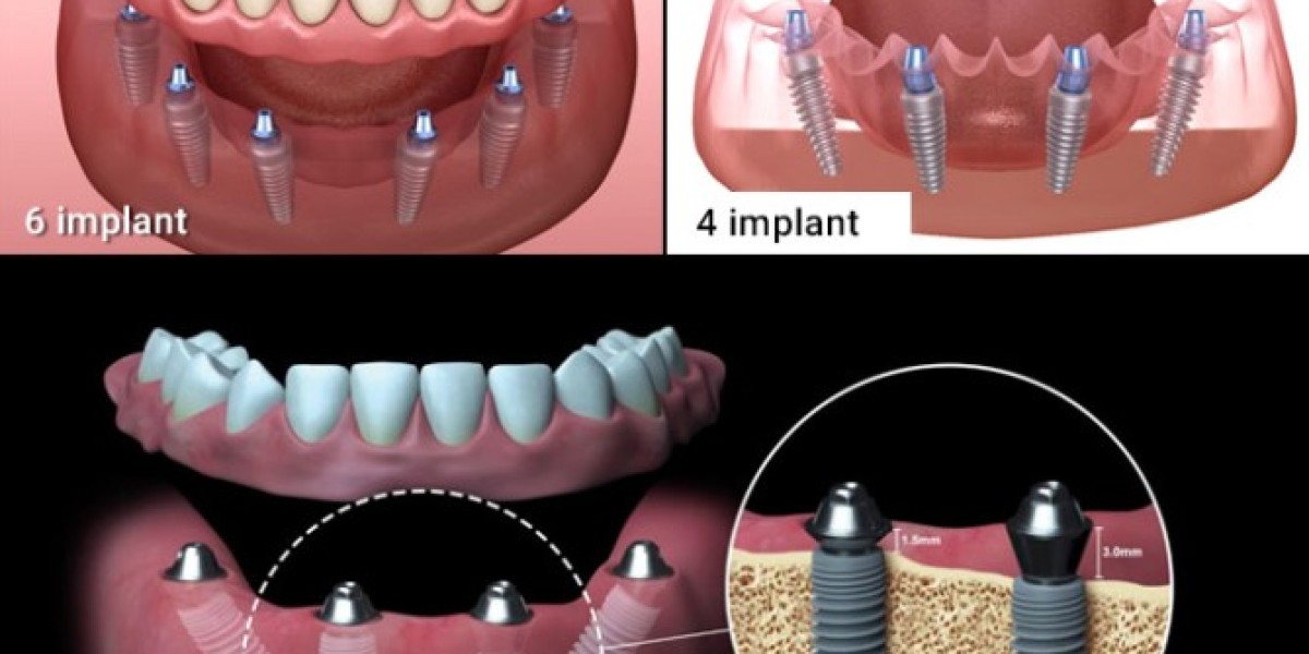 Tất tần tật về chi phí trồng răng Implant cho những ai chưa biết