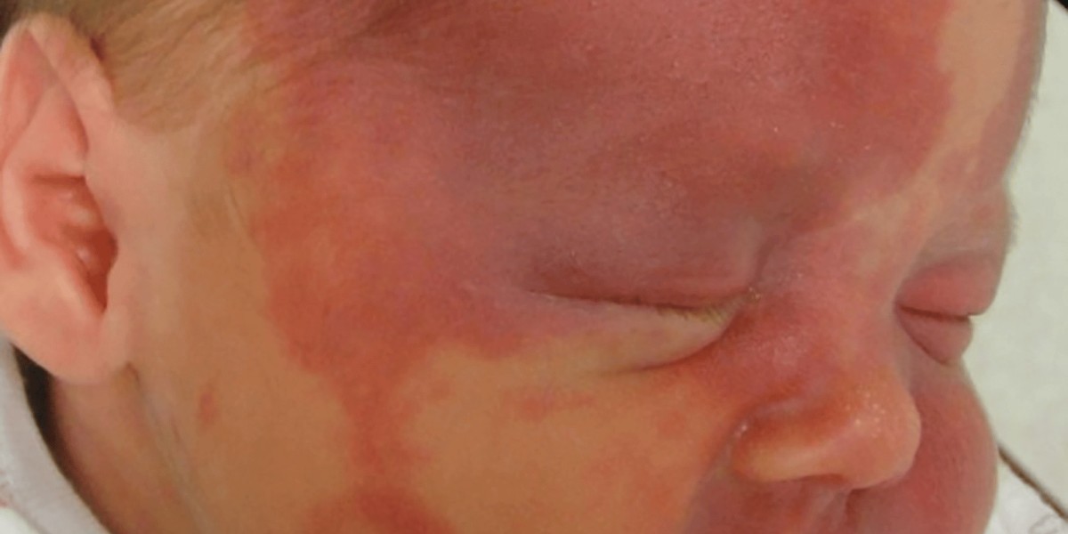 Is Port Wine Stains Treatment Safe for Children?