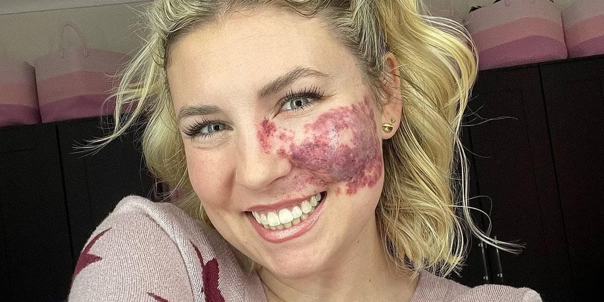 What Causes Port Wine Stains on the Skin?