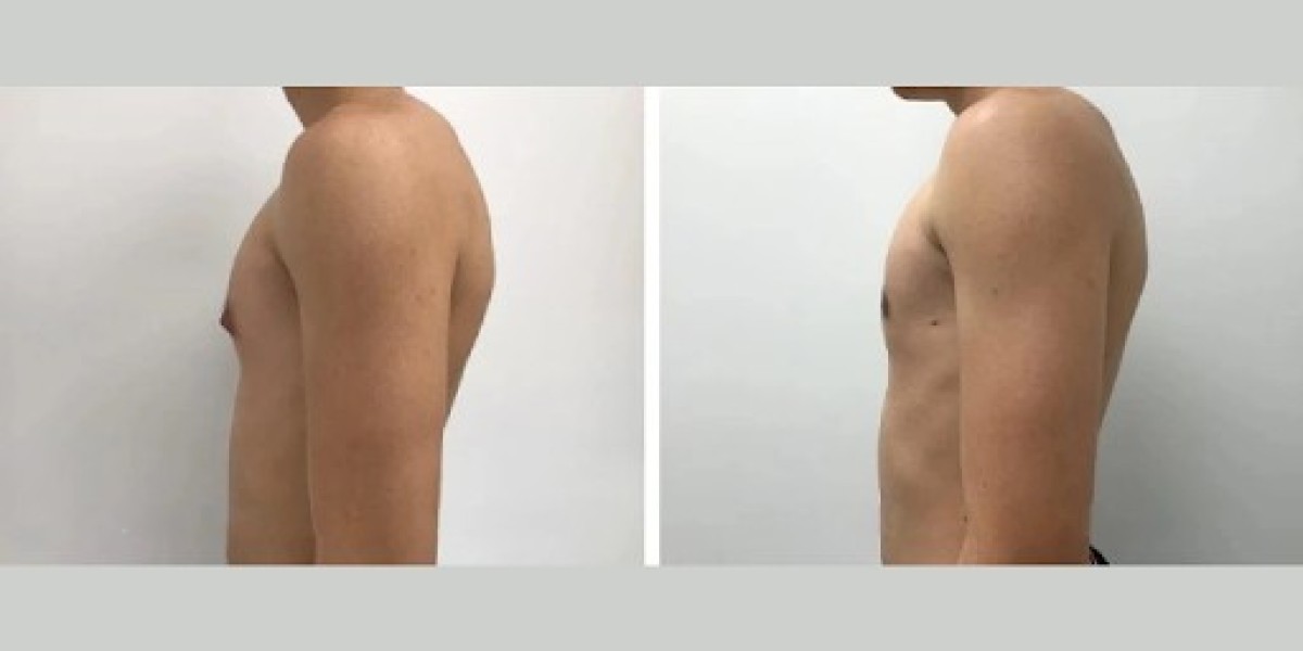 Best Surgeon in Dubai for Teens with Gynecomastia
