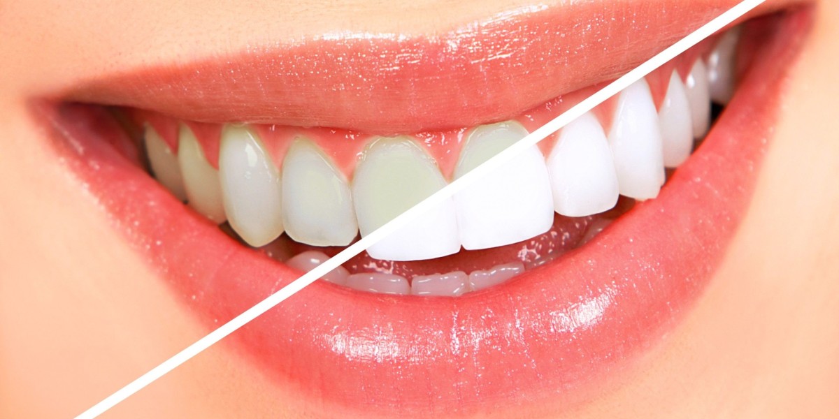 Affordable Teeth Whitening Cost Options That Still Work