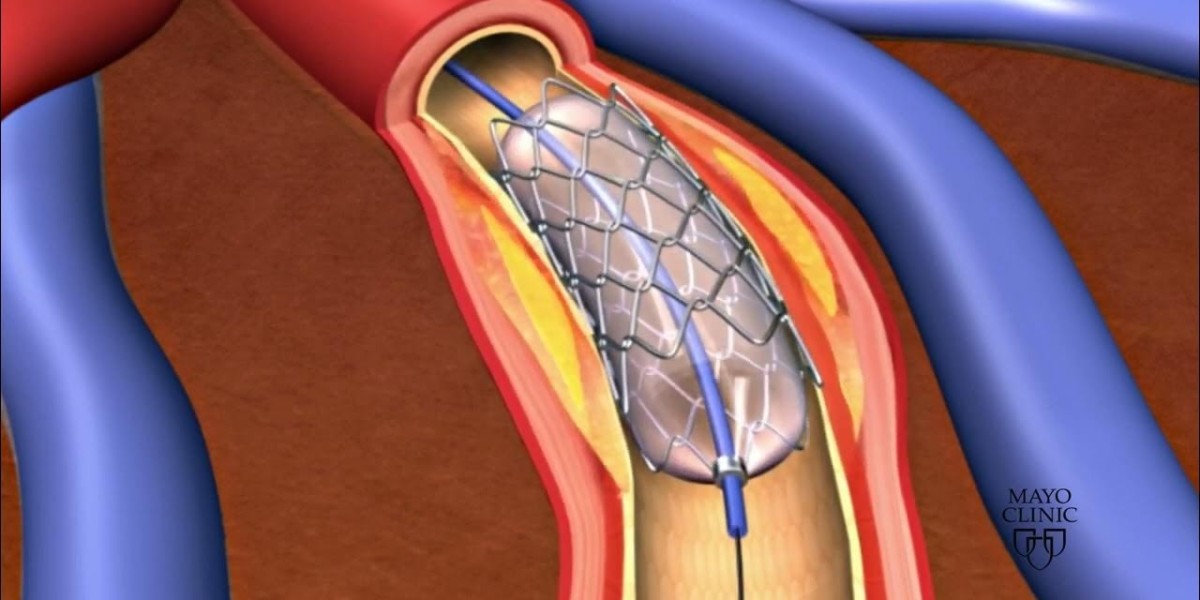 The Expanding Airway Stent Market: Trends, Innovations, and Future Growth