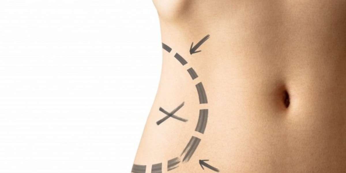 Where to Get High-Definition Vaser Liposuction in Riyadh
