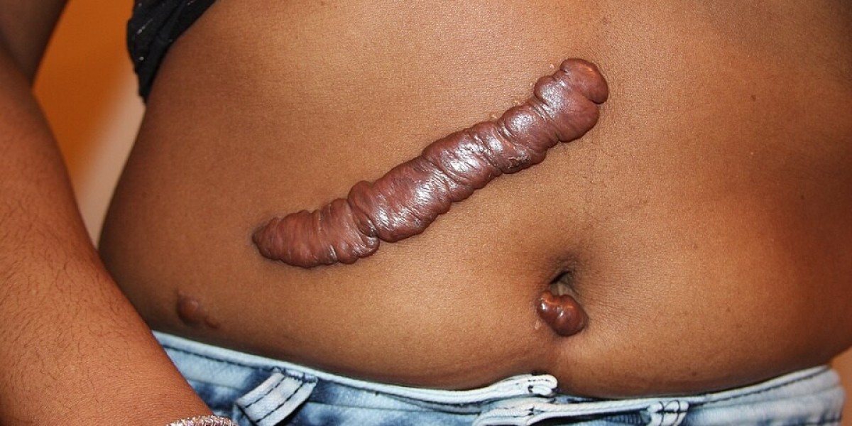 Do Keloid Treatments Work On Dark Skin?