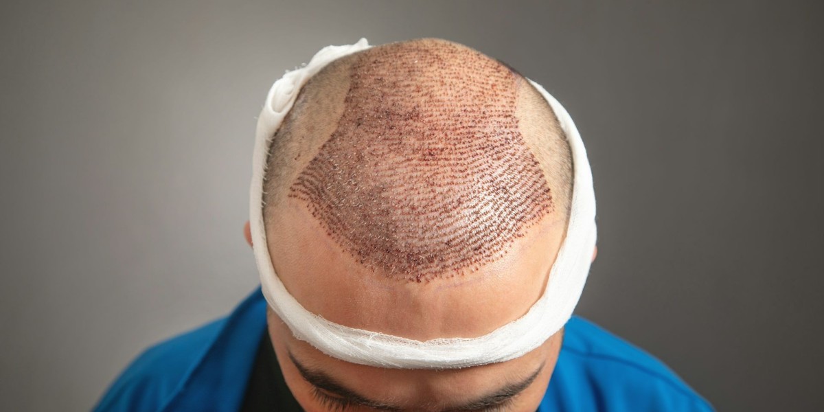 What Is a Hair Transplant and How Does It Work in Islamabad?