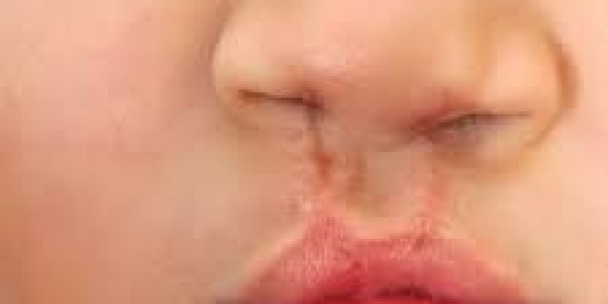 Cleft Lip and Palate Treatment in Islamabad: A Lifeline for Children and Families