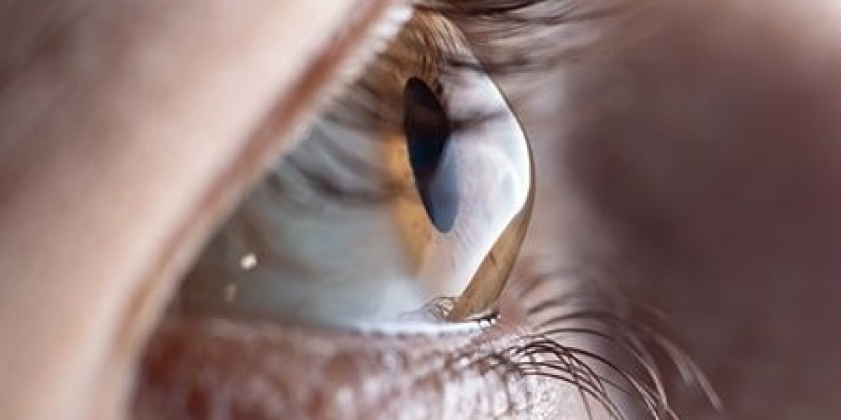 LASIK Eye Surgery in London: Advanced Vision Correction with Lasting Results