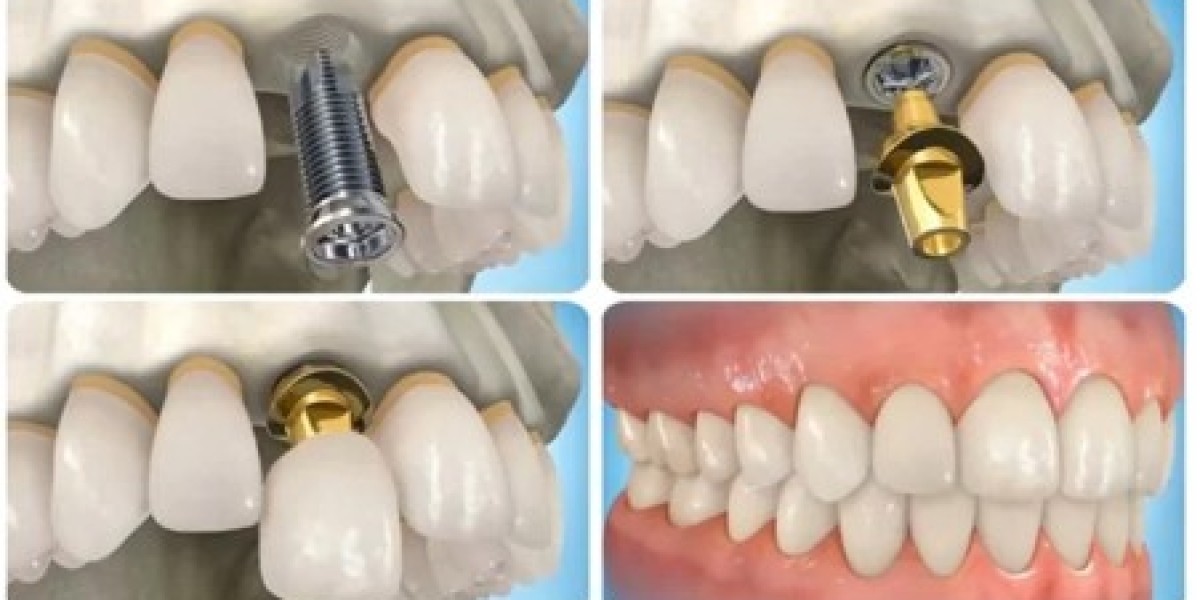 Trồng răng Implant nhanh nhất là bao lâu?