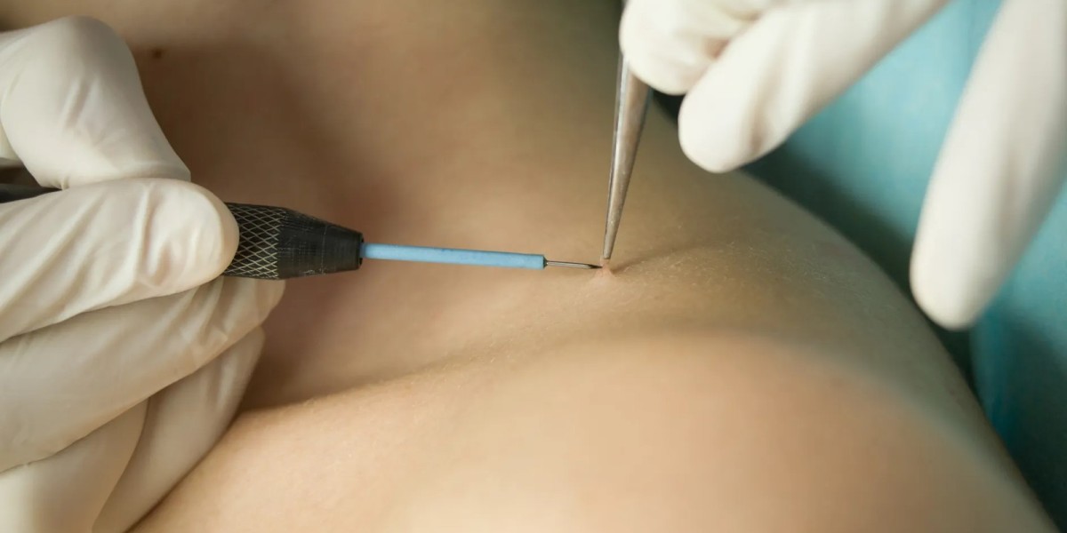 What Is The Best Method For Skin Tag Removal?