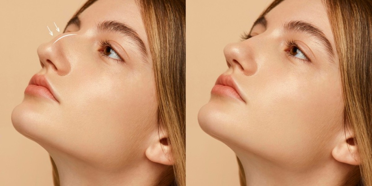 What Rhinoplasty Price Says About Your Next Glow-Up Move