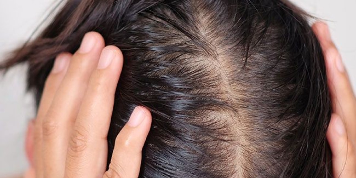 Can Women Benefit from Hair Transplant in Riyadh? Here’s What to Know