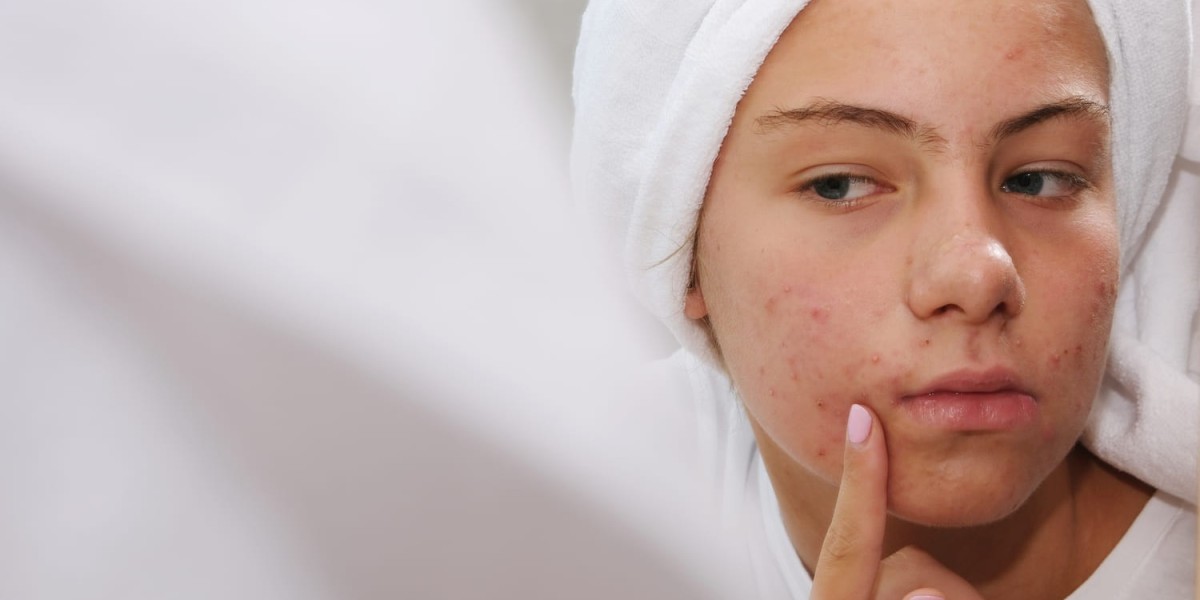 What Is the Best Acne Treatment for Adult Acne Patients?