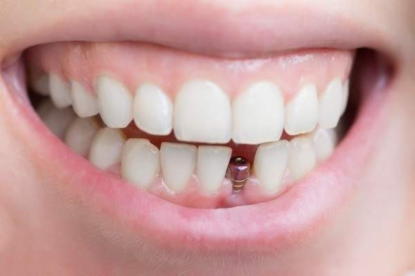 dental implants Perth