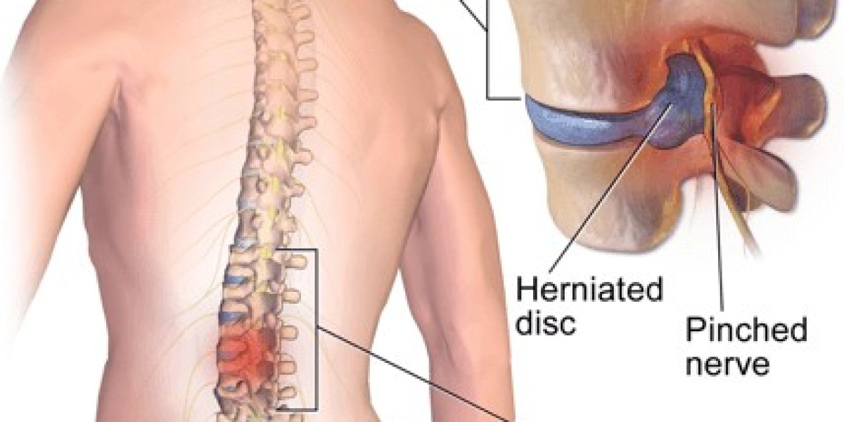 Managing Post‑Amputation Pain: Effective Aspadol 200 mg Regimens