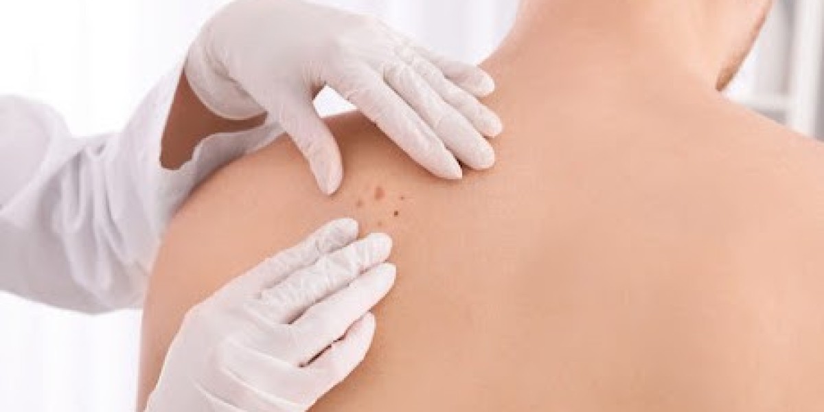 What Is Dermoscopy Mole Evaluation Used For?