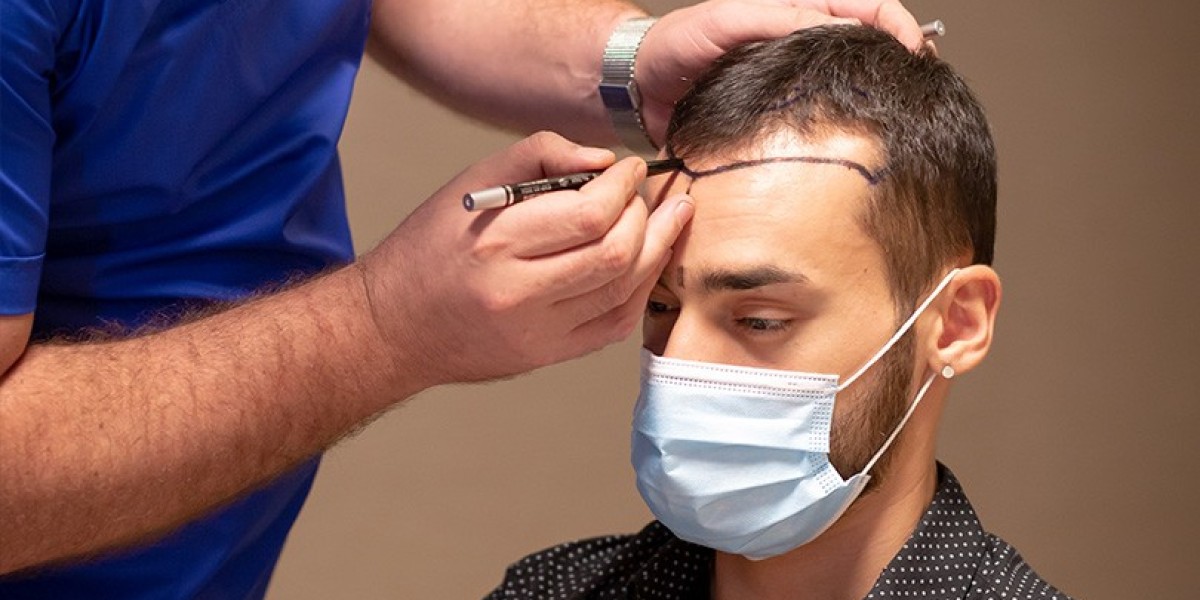 Why Hair Transplant in Dubai Keeps Gaining Popularity