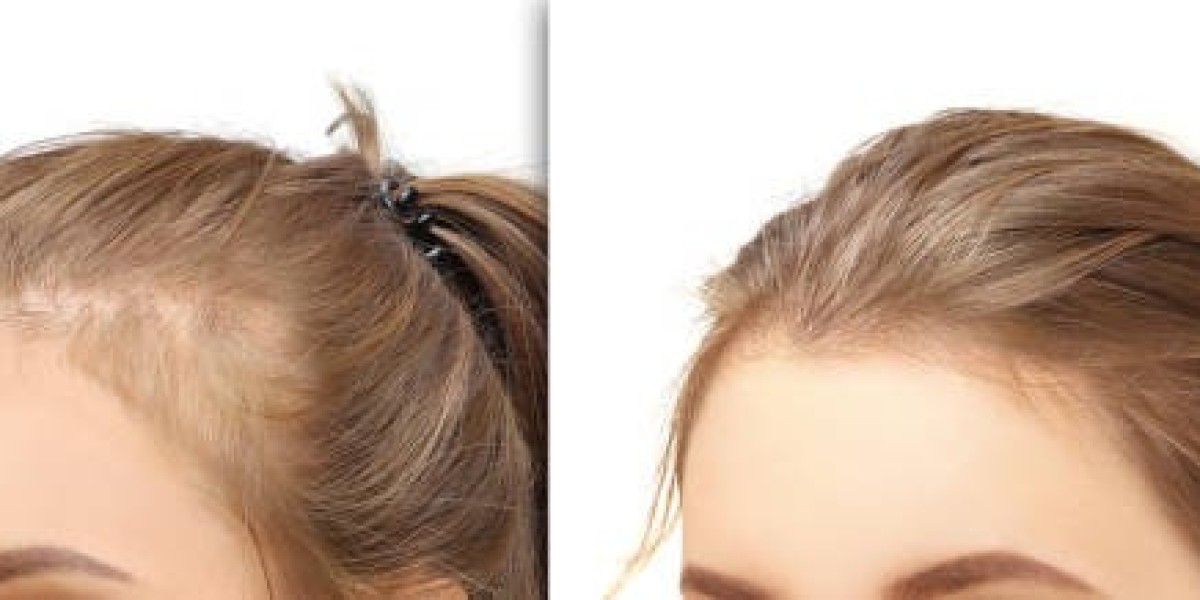 زراعة الشعر في الرياض: كل ما تحتاج معرفته قبل البدء