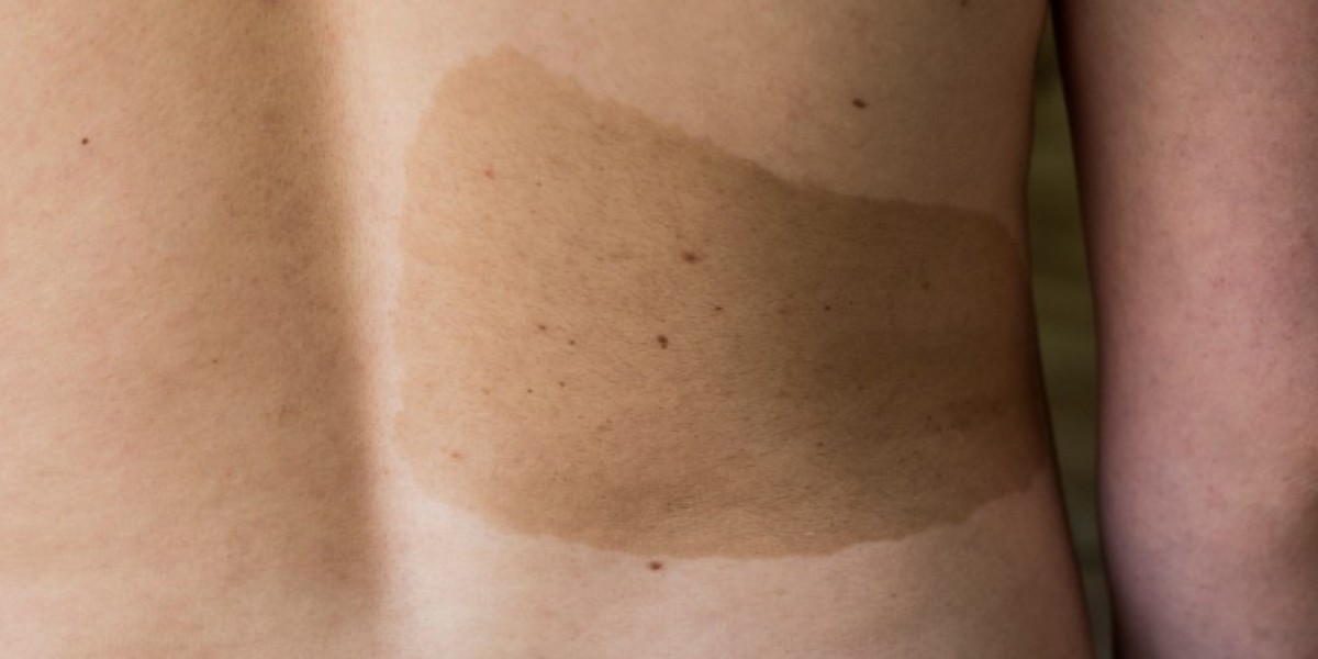 Can Birthmark Removal Treatment Cause Skin Discoloration?