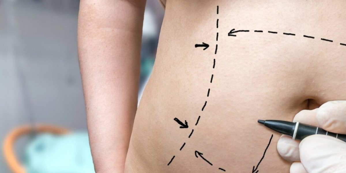 Top Benefits of a Tummy Tuck Surgery