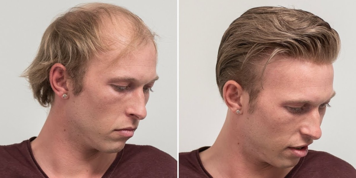 Is Hair Replacement Maintenance Too Much to Handle?