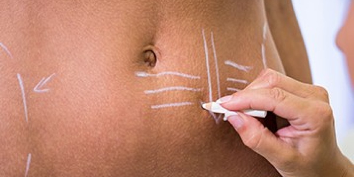 Liposuction Treatment in Delhi | Liposuction Cost in Delhi – Anaysha Aesthetics