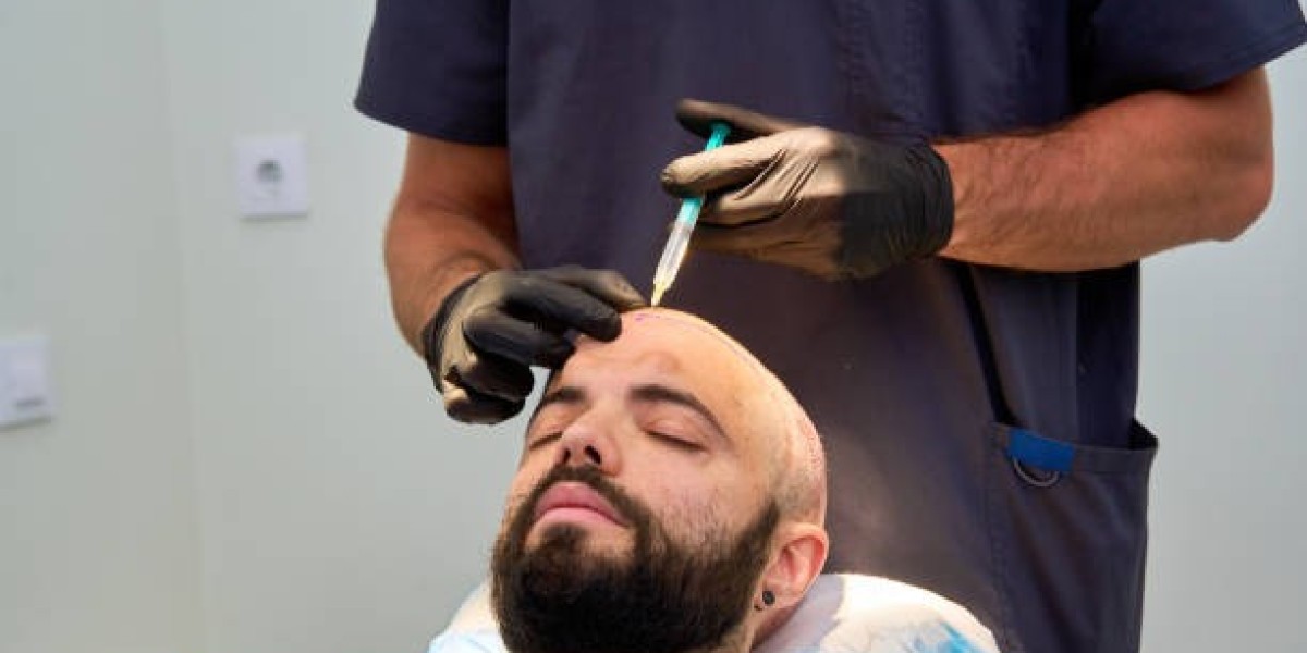 FUE Hair Transplant: Witnessing Your Transformation – Before and After